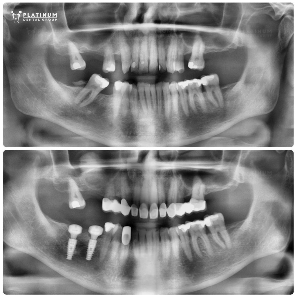 Nâng xoang răng 16, ghép xương răng 46, 47 và thực hiện trồng 2 trụ Implant