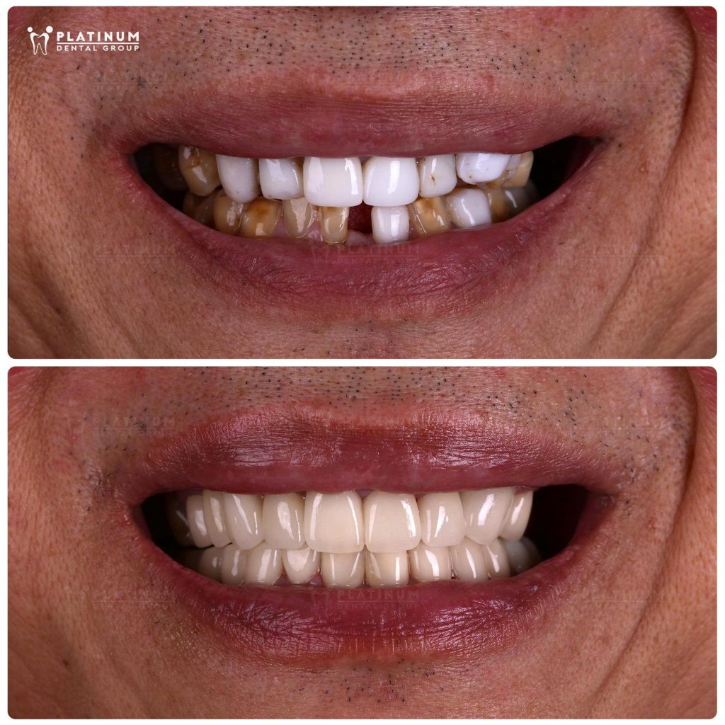 Before and After Dental Crowns