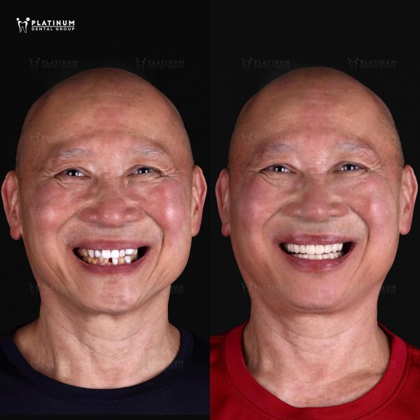 his chewing function improved significantly thanks to precise bite calibration performed by Dr. Lan Anh