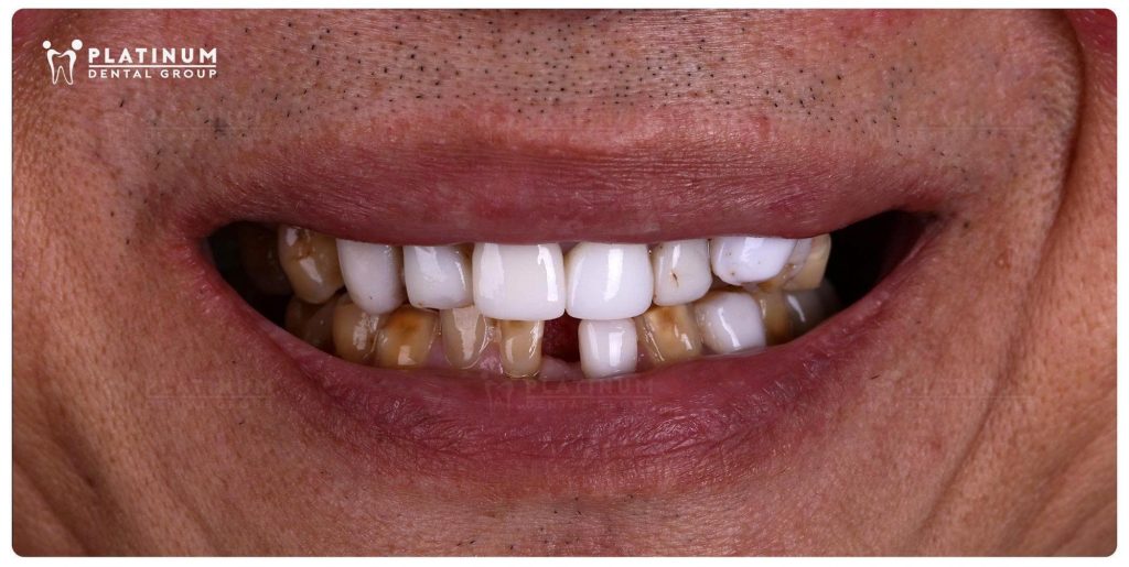 From an Unnatural Smile to Renewed Confidence