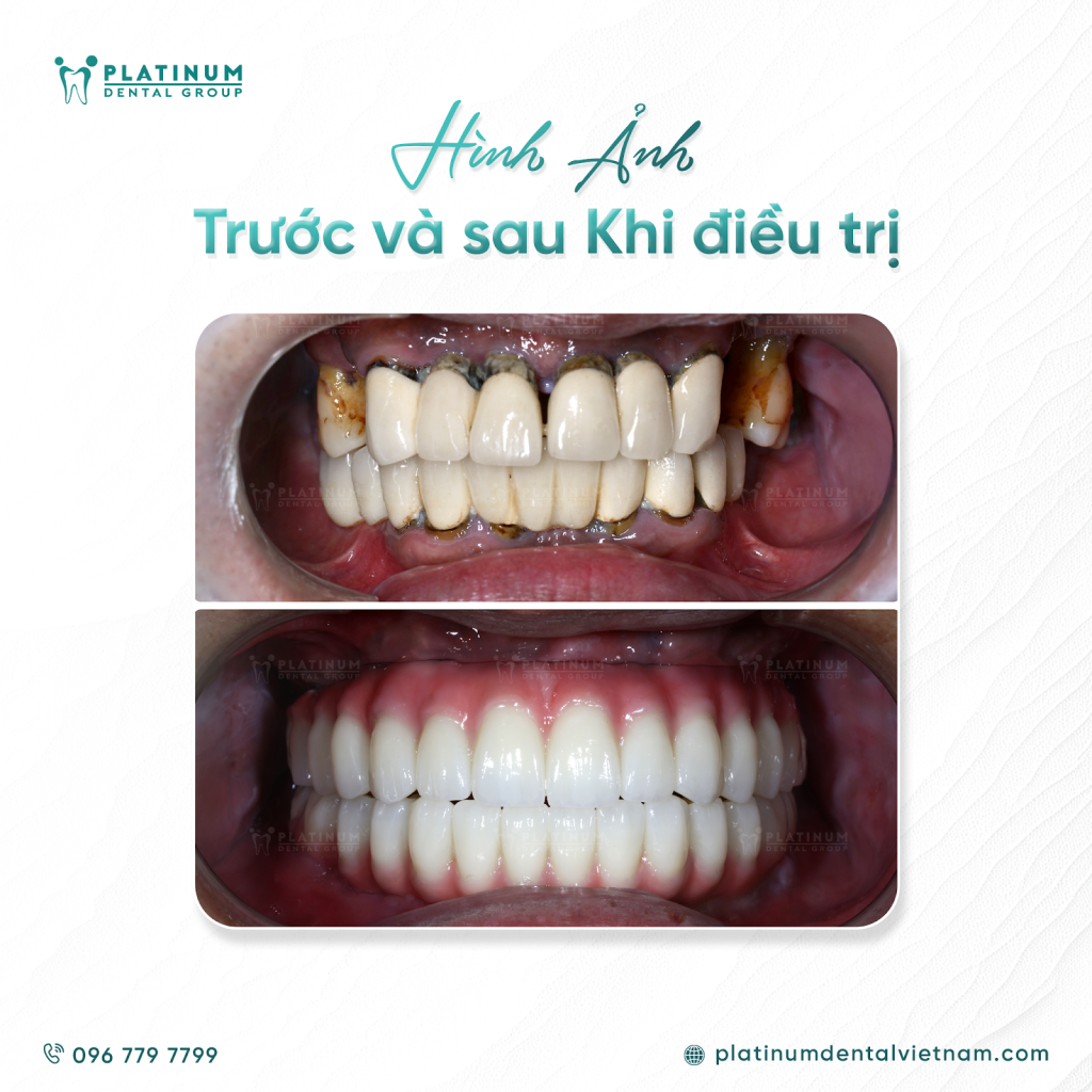 PHỤC HỒI RĂNG TOÀN HÀM CHO VIỆT KIỀU MỸ: KHI HY VỌNG ĐƯỢC THẮP SÁNG TẠI PLATINUM DENTAL 4 Hình ảnh trước và sau khi điều trị của anh L.V