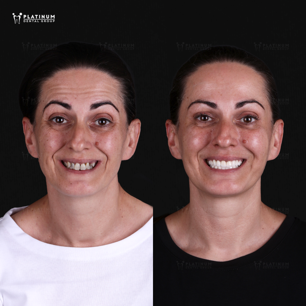 Ms. Naime Jacka: Rediscovering 20 Years of Youth Through Dental Tourism at Platinum Dental