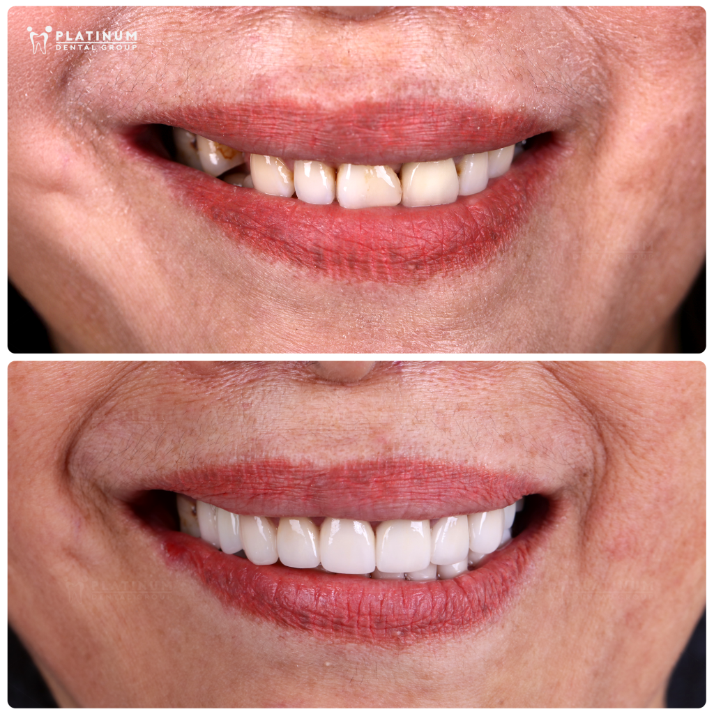 Cosmetic Porcelain Restorations
