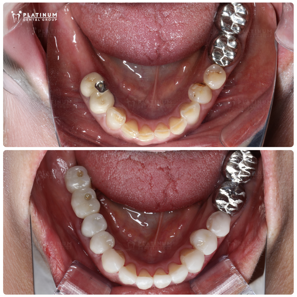 các nếp nhăn do mất răng được làm đầy
