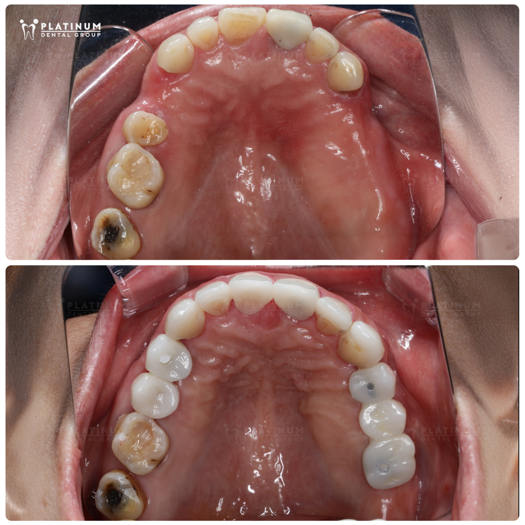 The seamless integration of modern Implant technology