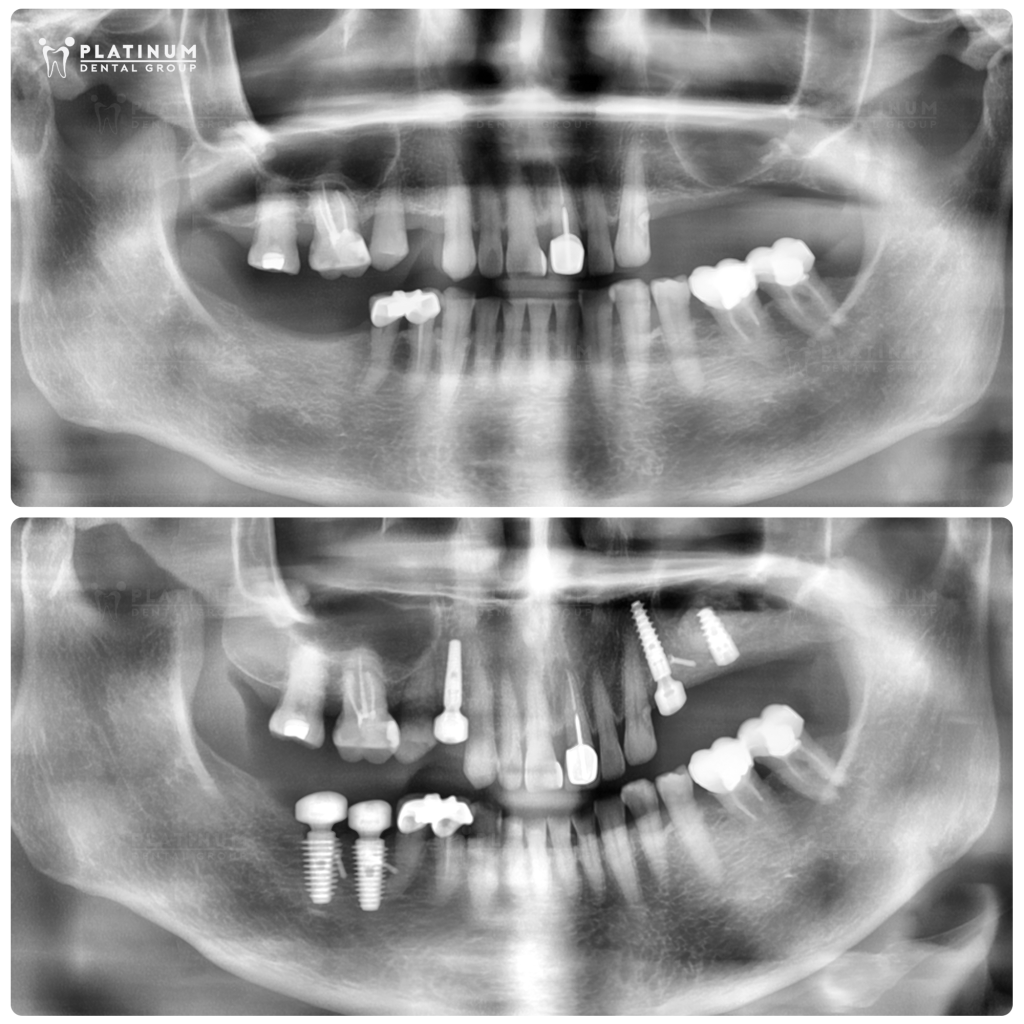 Cấy ghép 5 trụ Implant cho cô Hiên