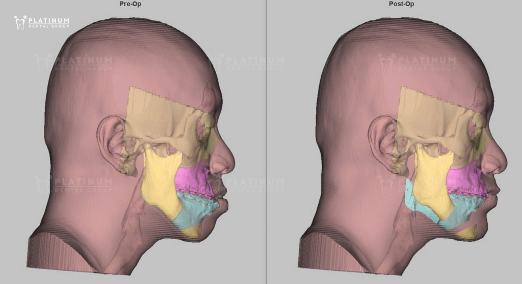 Dấu hiệu nhận biết cằm bị lệch