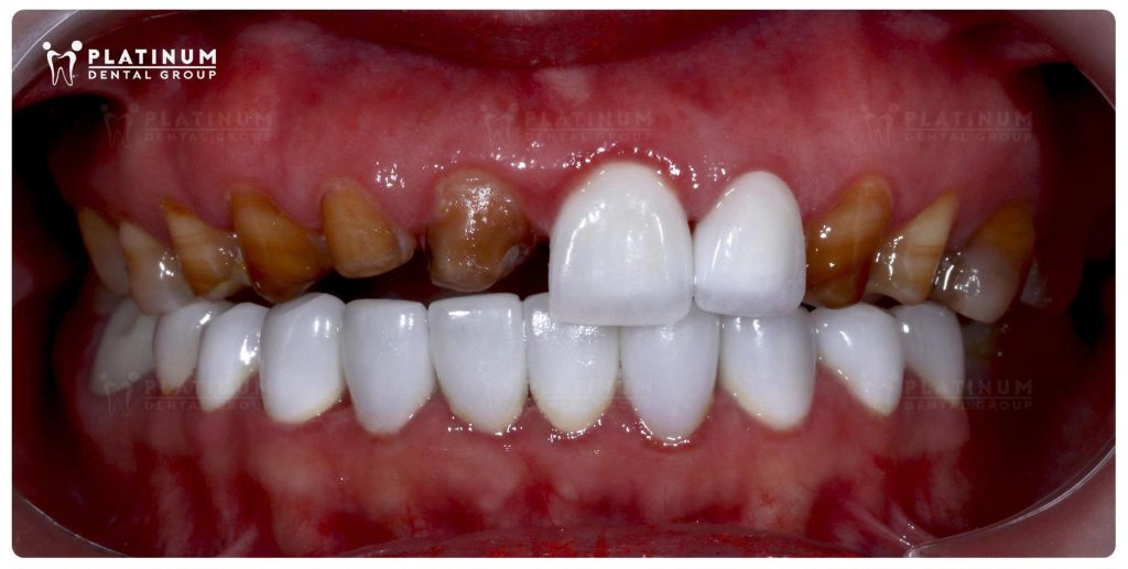 2026 - 2 years ago: Upper veneers done elsewhere kept coming off - Lower veneers at Platinum Dental remained strong and healthy
