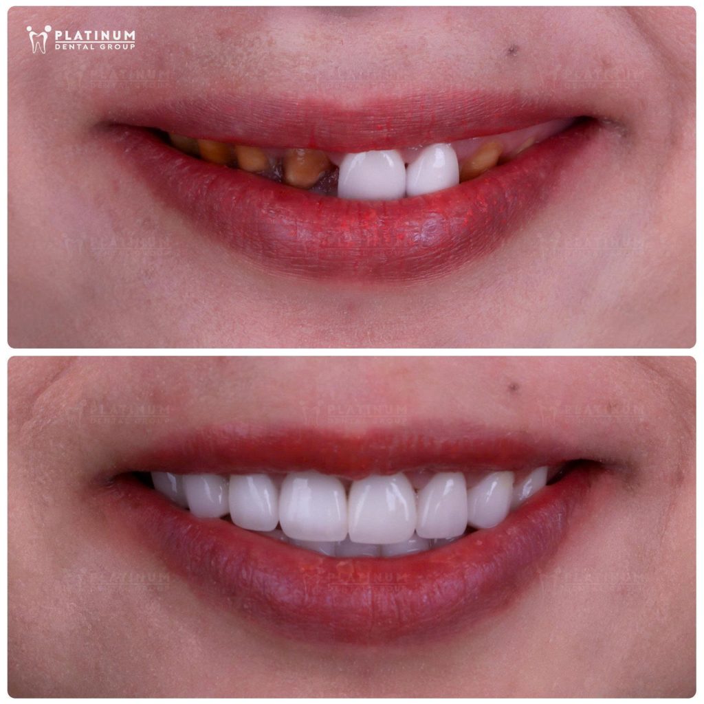 chị Hương đã bay về Việt Nam và đến Platinum Dental lần thứ hai