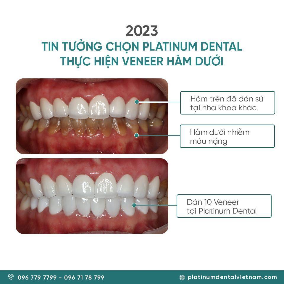 Cột mốc 2023 khi chị Vân Hương đến Platinum Dental