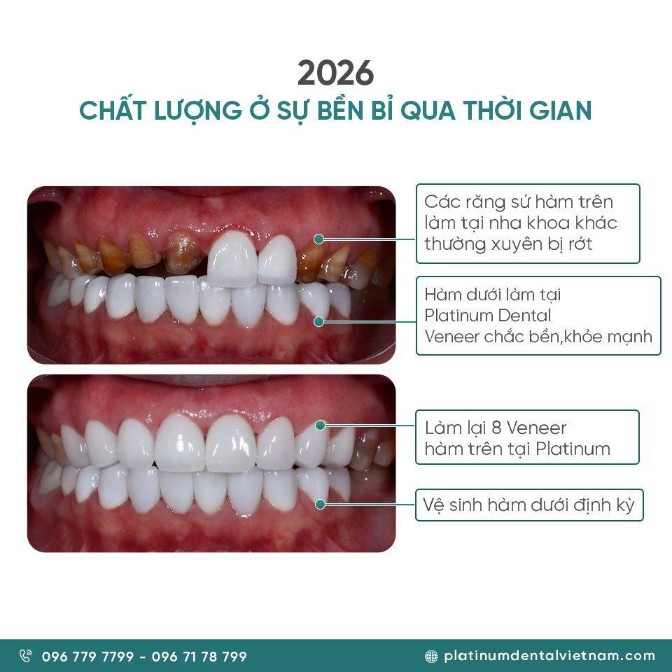 Và 2026 trở lại làm Veneer hàm trên của chị