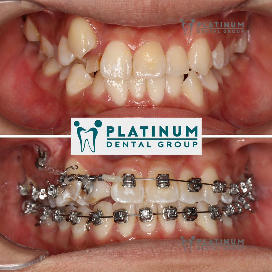 Chỉnh nha là gì? 4 phương pháp chỉnh nha phổ biến hiện nay 2 Chỉnh nha (hay niềng răng) là phương pháp nha khoa chuyên sâu sử dụng khí cụ (mắc cài, khay trong suốt) để sắp xếp, di chuyển răng về đúng vị trí chuẩn