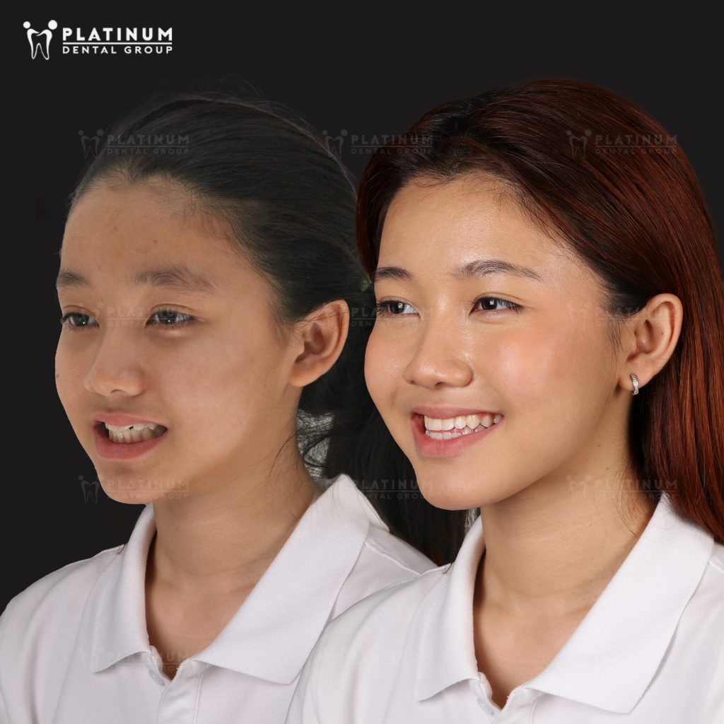 Chỉnh nha là gì? 4 phương pháp chỉnh nha phổ biến hiện nay 11 Giai đoạn thanh thiếu niên thường được xem là thời điểm thuận lợi để chỉnh nha