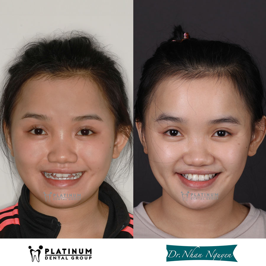 Chỉnh nha là gì? 4 phương pháp chỉnh nha phổ biến hiện nay 7 Chỉnh nha giúp sắp xếp lại vị trí răng, cải thiện sự hài hòa của nụ cười và nét mặt theo hướng tự nhiên