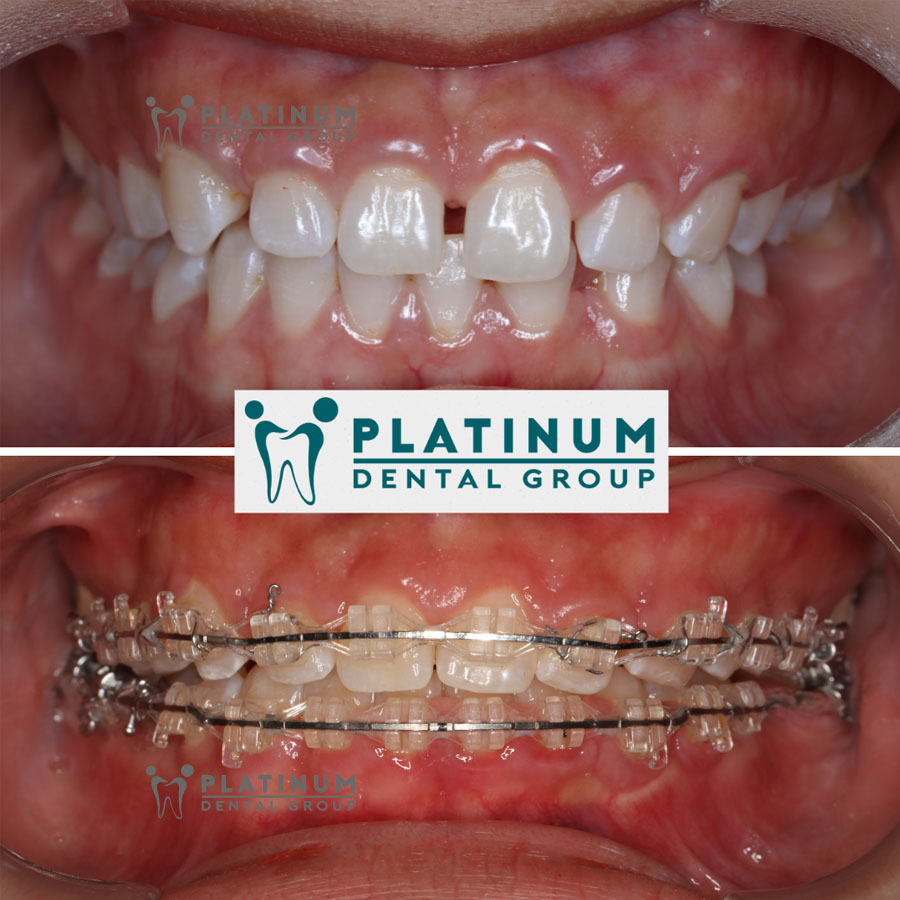 Chỉnh nha là gì? 4 phương pháp chỉnh nha phổ biến hiện nay 8 Niềng răng mắc cài kim loại là phương pháp chỉnh nha truyền thống và vẫn được sử dụng rộng rãi