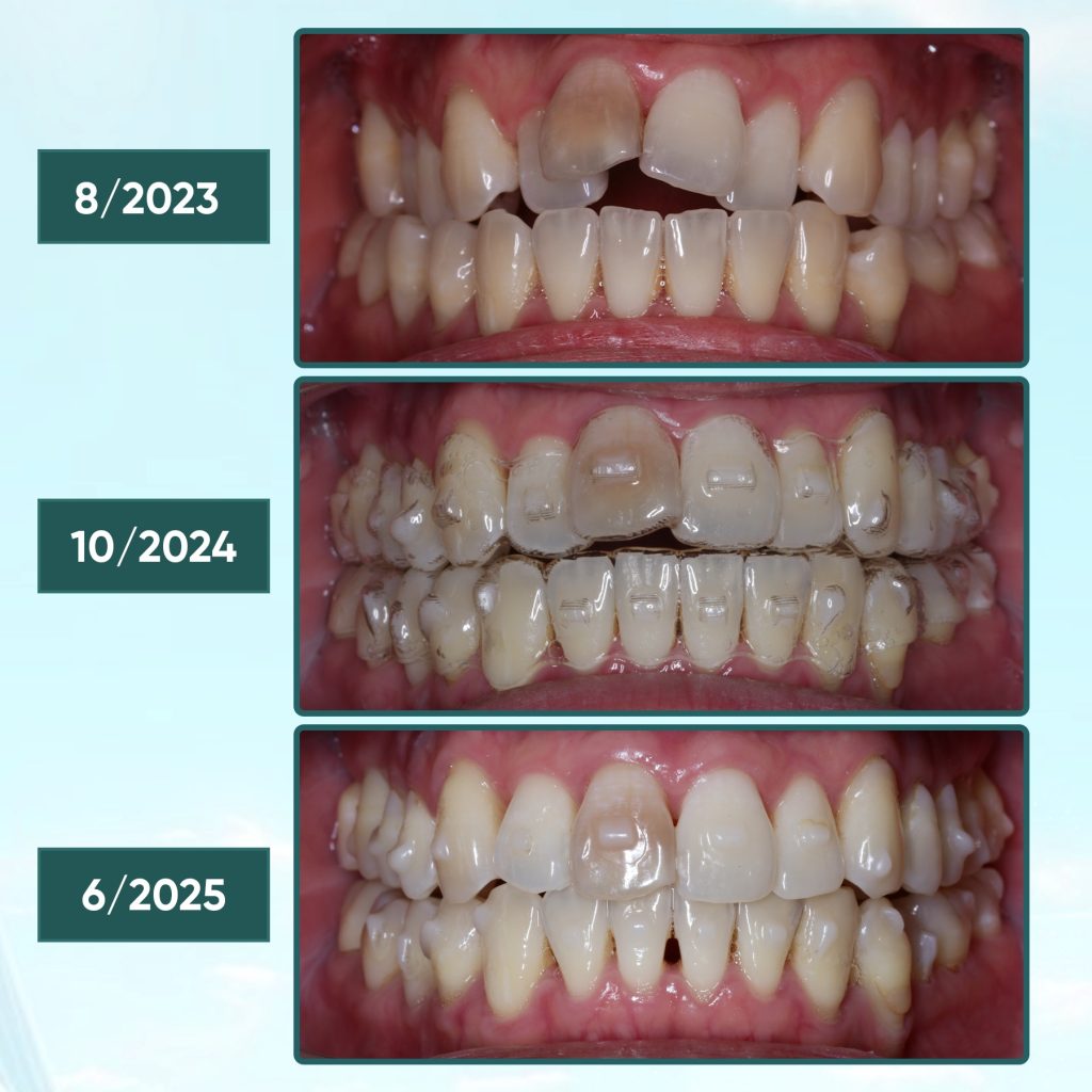Chỉnh nha là gì? 4 phương pháp chỉnh nha phổ biến hiện nay 9 Chỉnh nha bằng khay trong suốt có tính thẩm mỹ cao