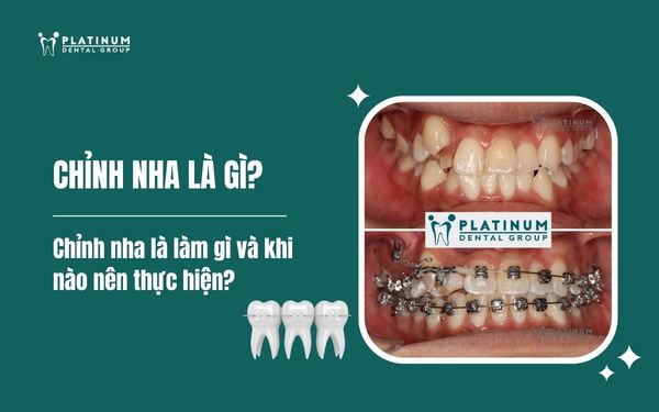 chỉnh nha là gì