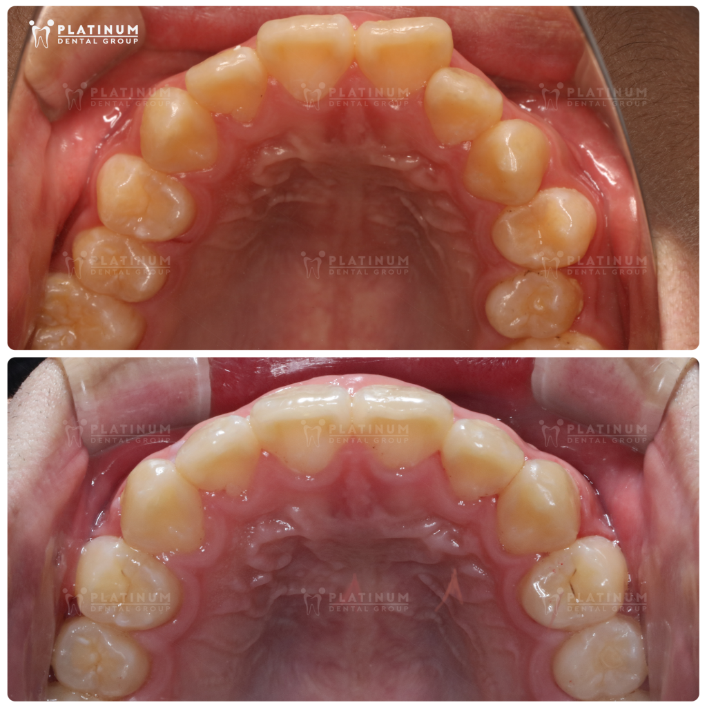 Can thiệp đúng giai đoạn tăng trưởng để hỗ trợ xương hàm phát triển theo hướng hài hòa hơn