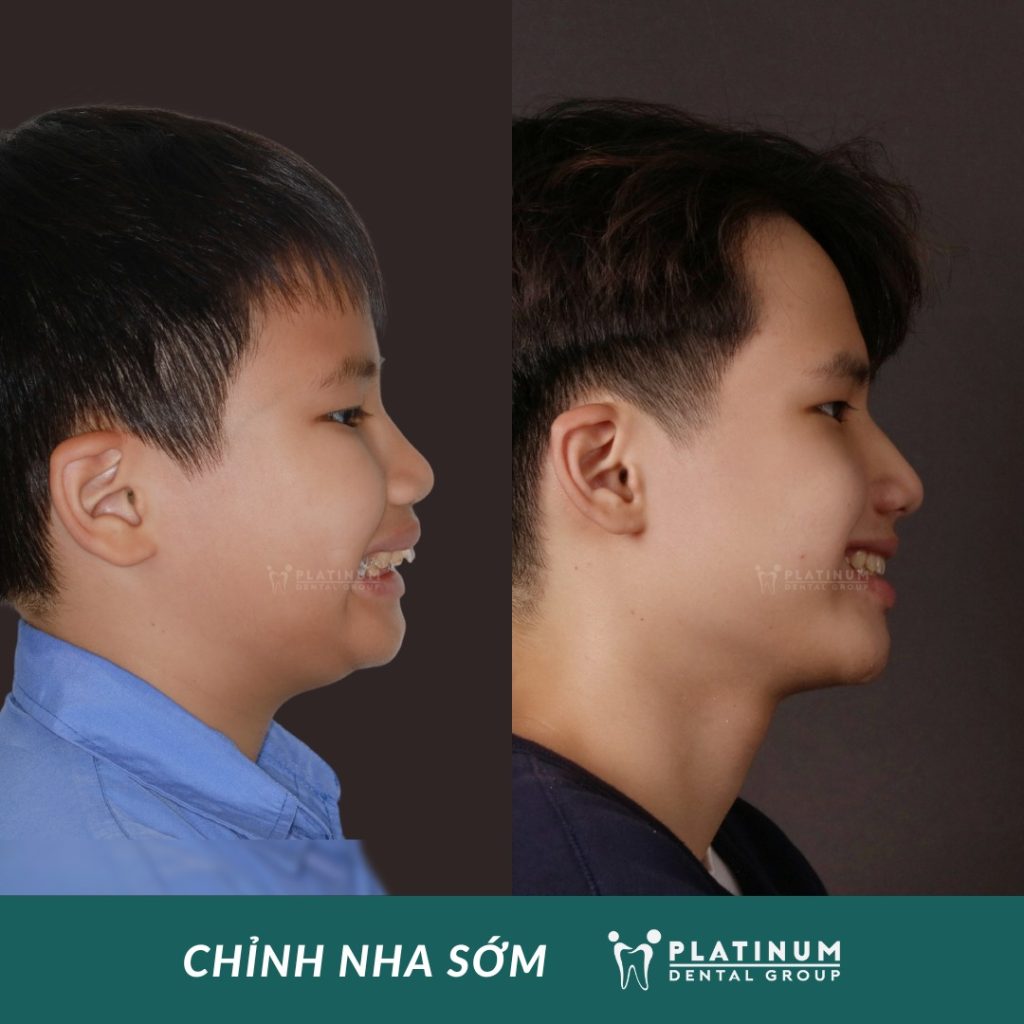 Trẻ trong giai đoạn từ 6 đến 12 tuổi có dấu hiệu hàm hô, mặt phát triển không cân đối thì nên thực hiện chỉnh nha tăng trưởng