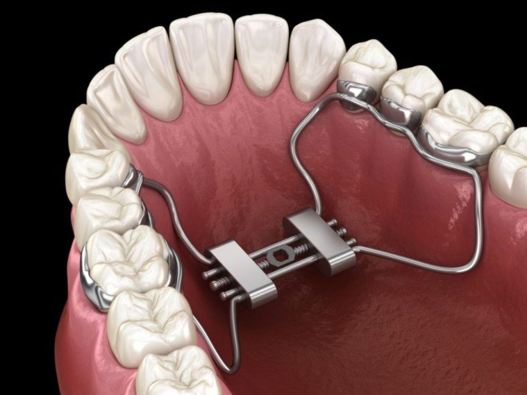 Khí cụ tháo lắp chỉnh hình xương hàm