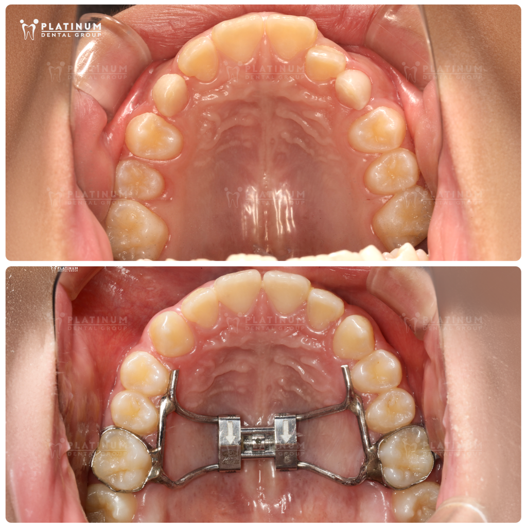 Đeo khí cụ đúng số giờ bác sĩ chỉ định