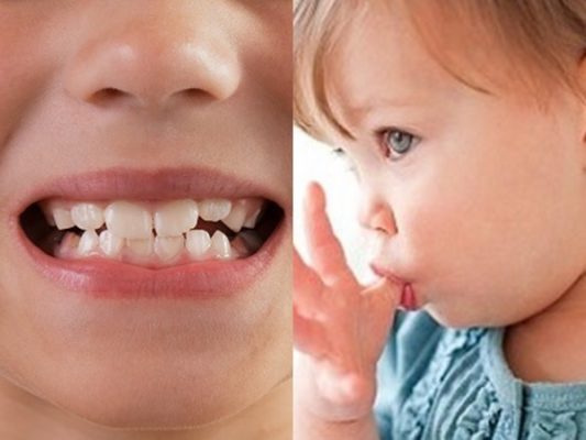 Có rất nhiều yếu tố có thể gây khớp cắn ngược ở trẻ