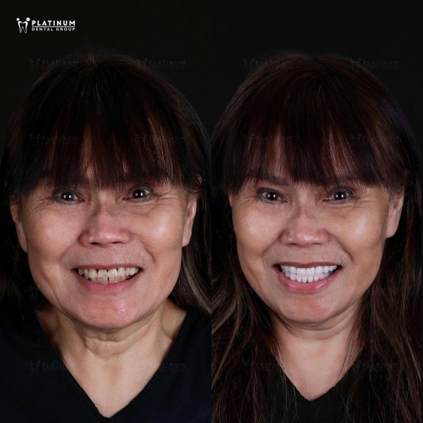 Bí quyết trẻ khỏe tuổi 70