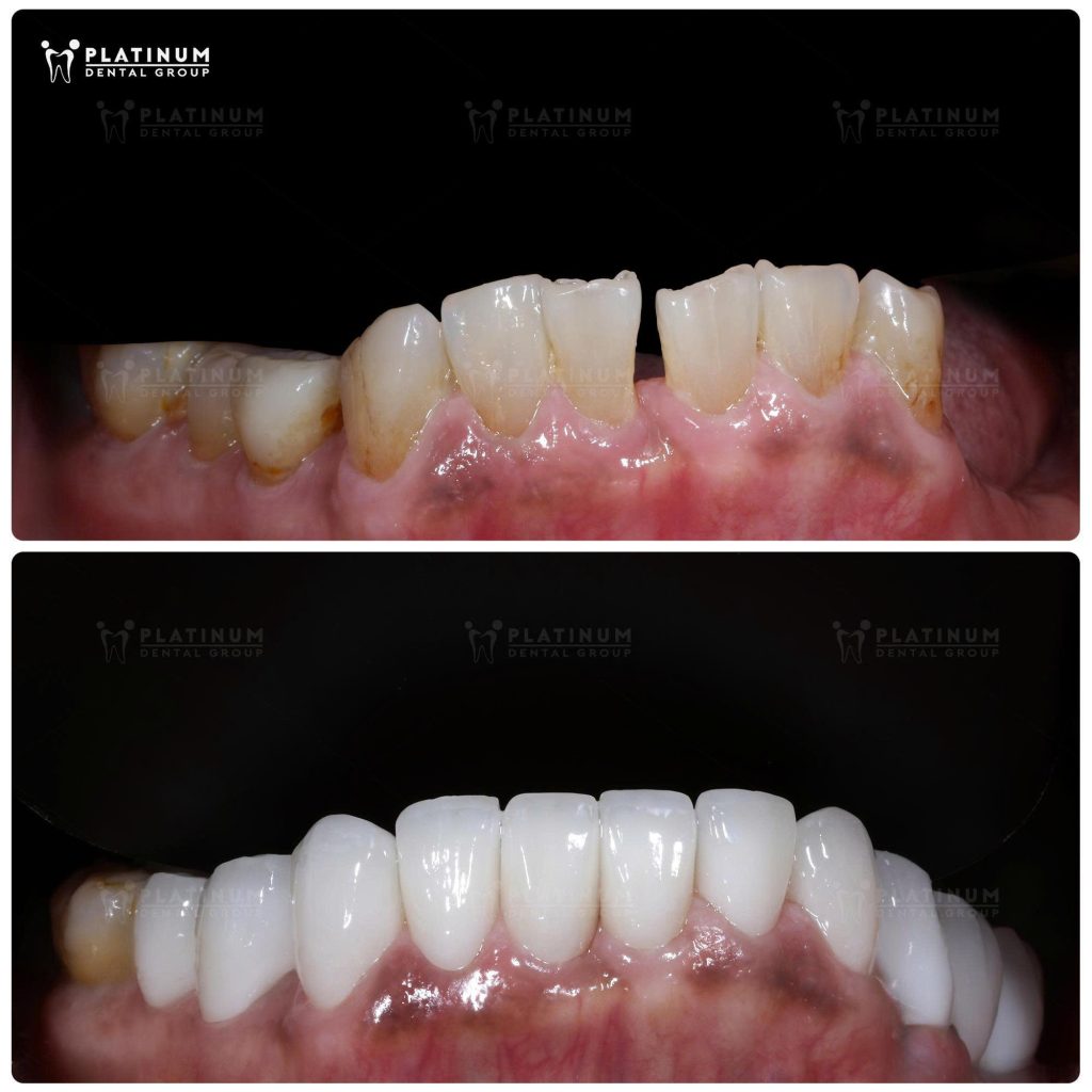 Ảnh mão sứ hàm dưới - Tuyết Mai