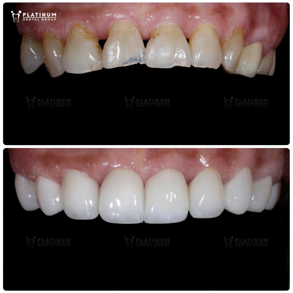 Ảnh mão sứ hàm trên - Tuyết Mai