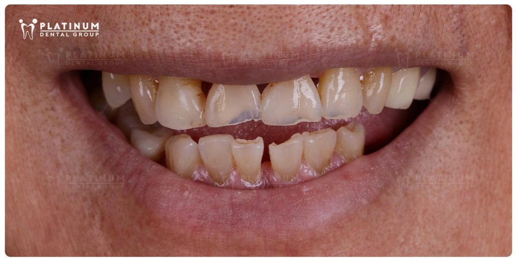 Tình trạng răng ban đầu khi tới, cô có các răng nhiễm màu, mòn mặt cắn, mất răng