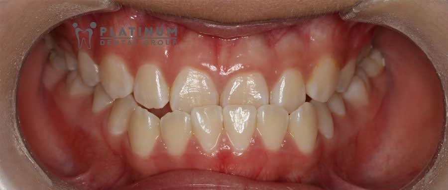 Dấu hiệu nhận biết khớp cắn ngược ở trẻ nhỏ