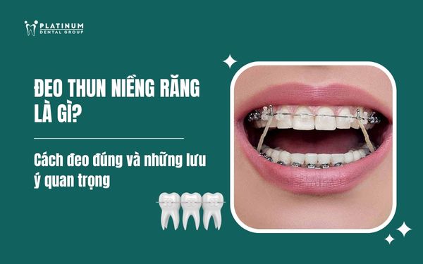 Đeo thun niềng răng