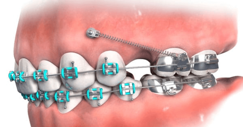 Giai đoạn đóng khoảng giúp kéo các răng lại gần nhau để lấp đầy khoảng trống trên cung hàm