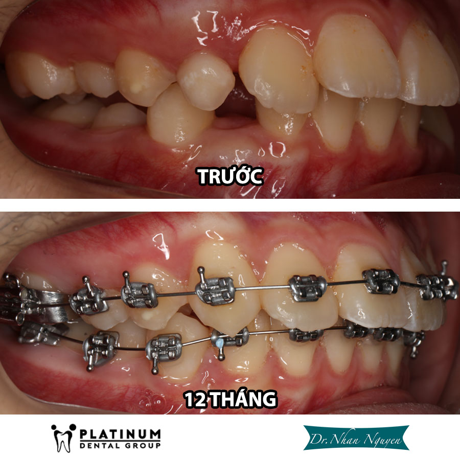 Giai đoạn đóng khoảng giúp răng dịch chuyển về vị trí lý tưởng và cải thiện khớp cắn