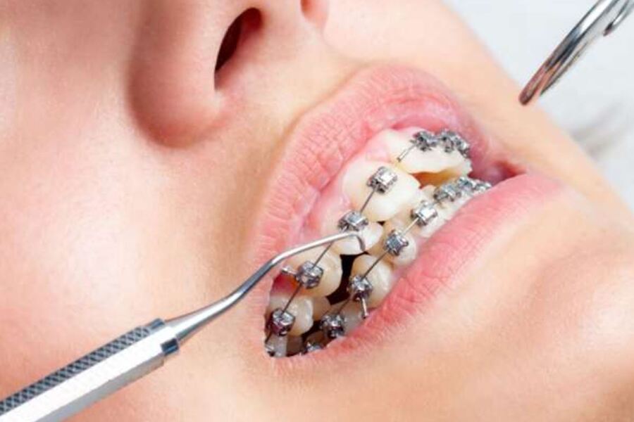 Giai đoạn đóng khoảng thường bắt đầu sau khi răng đã được sắp xếp tương đối thẳng hàng trong quá trình niềng răng