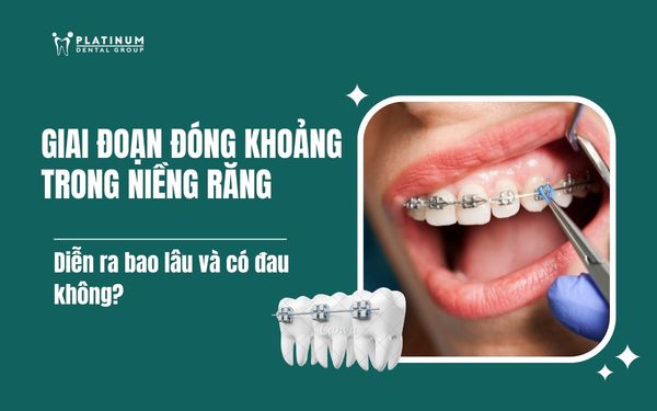 giai đoạn đóng khoảng trong niềng răng