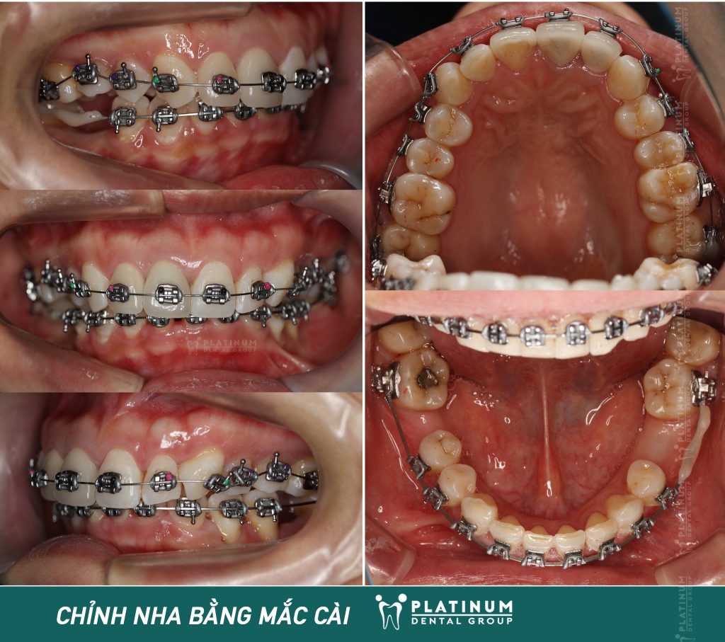 Giai đoạn làm quen khí cụ