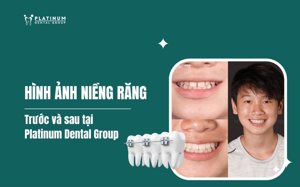 hình ảnh niềng răng