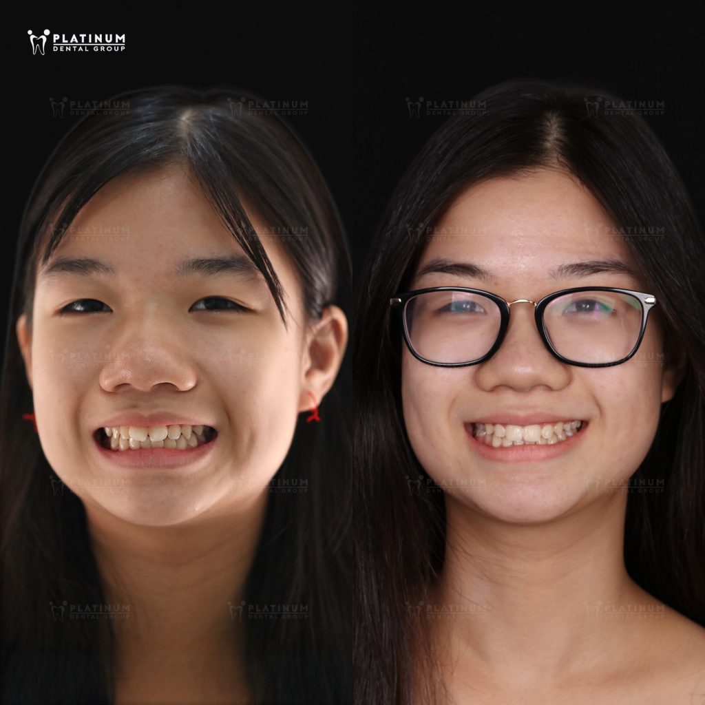 Hình ảnh niềng răng khấp khểnh, chen chúc