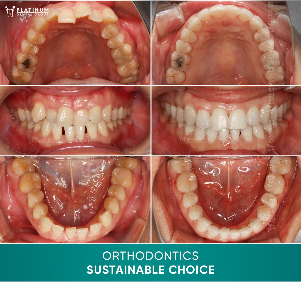 Hình ảnh niềng răng thưa