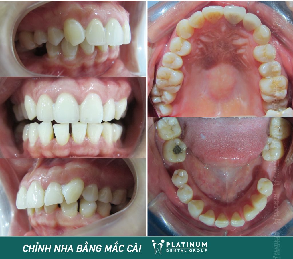 Hình ảnh răng chị Hoài Thanh trước khi niềng răng tại Platinum Dental Group