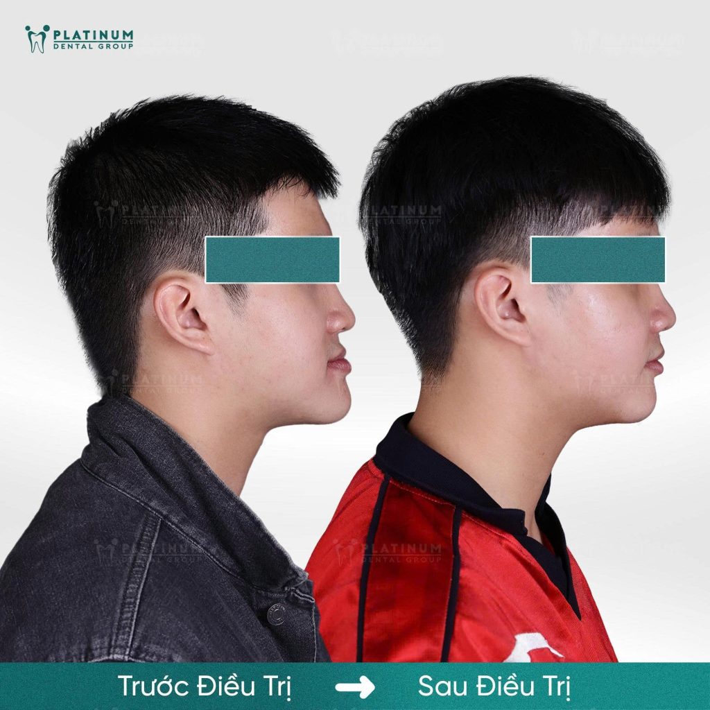 Kết hợp niềng răng và phẫu thuật