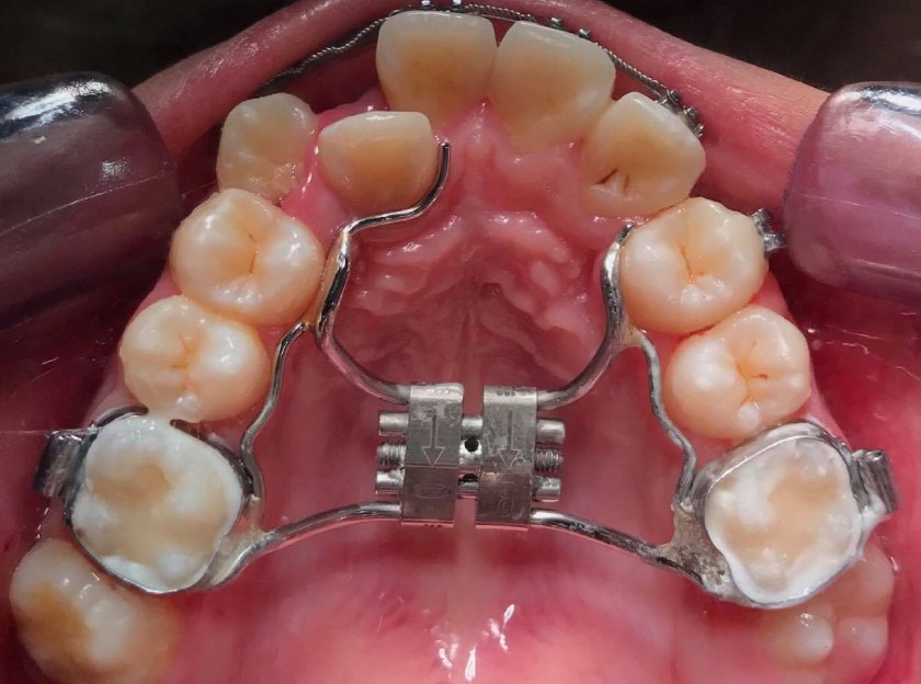 Khí cụ nong hàm cố định