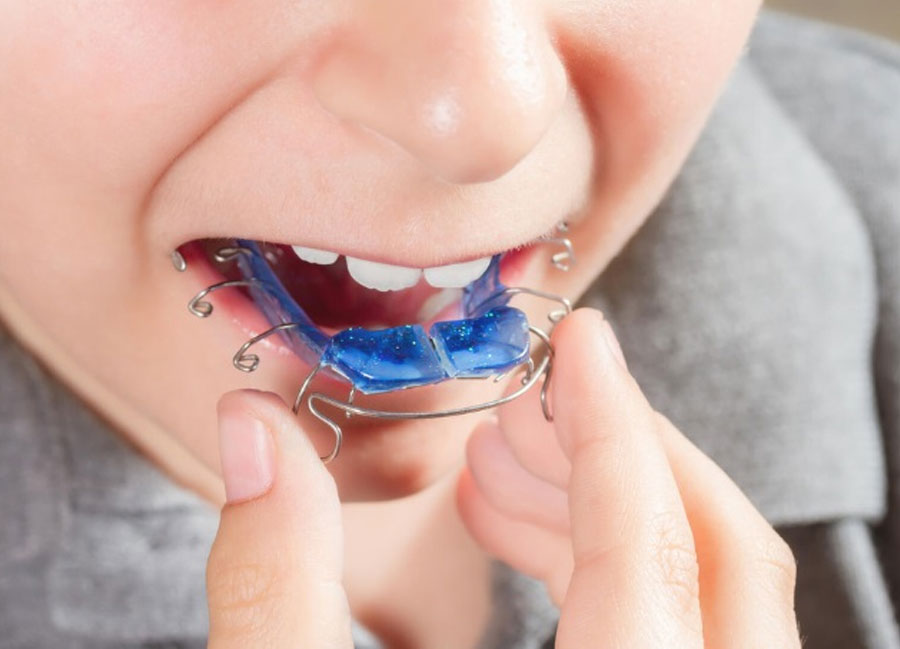 Khí cụ nong hàm giúp tạo khoảng trống cho răng nhưng cần chăm sóc răng miệng kỹ lưỡng