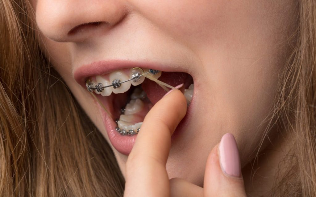 Không đeo thun niềng răng theo chỉ định có thể làm kéo dài thời gian chỉnh nha