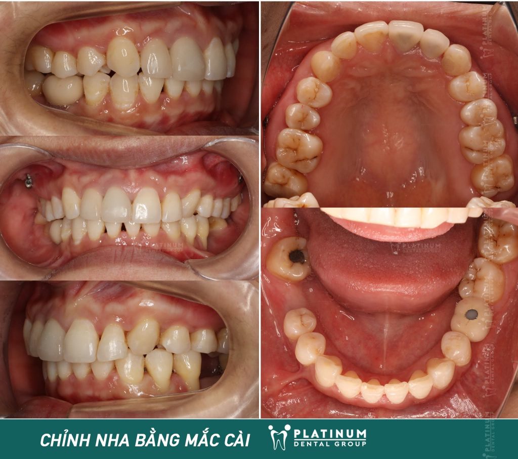 Khớp cắn dần được cải thiện rõ rệt