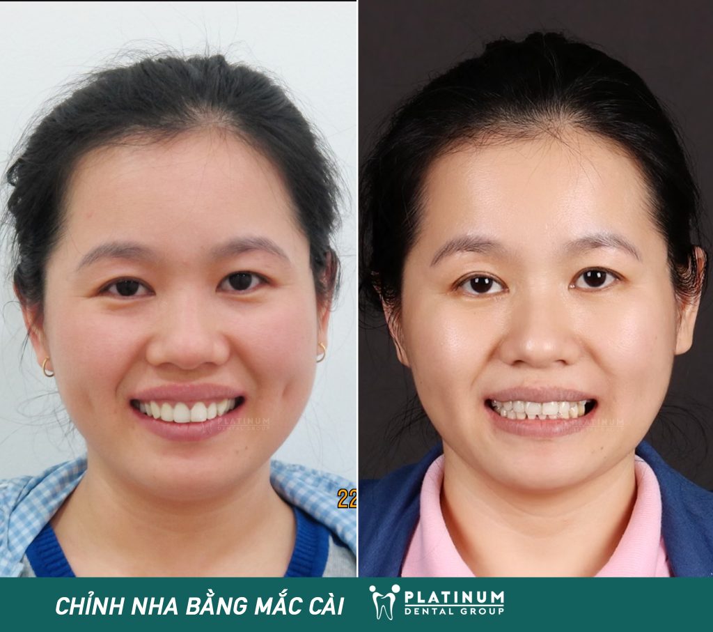 Ca niềng răng của chị Thanh thành công