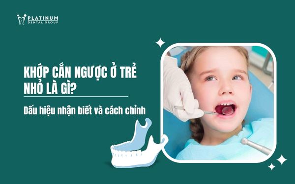 khớp cắn ngược ở trẻ nhỏ