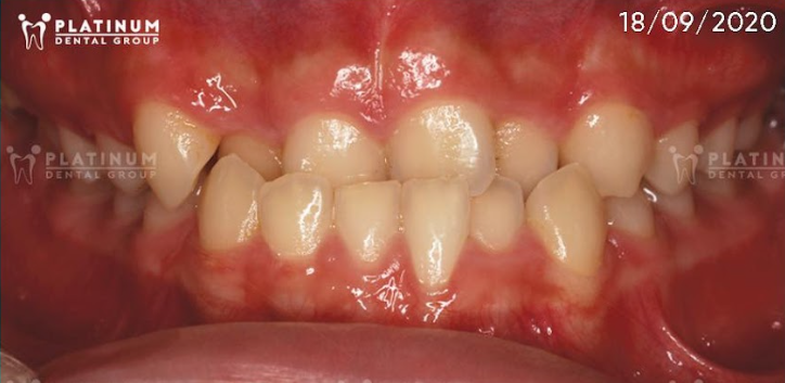 Khớp cắn ngược (underbite)