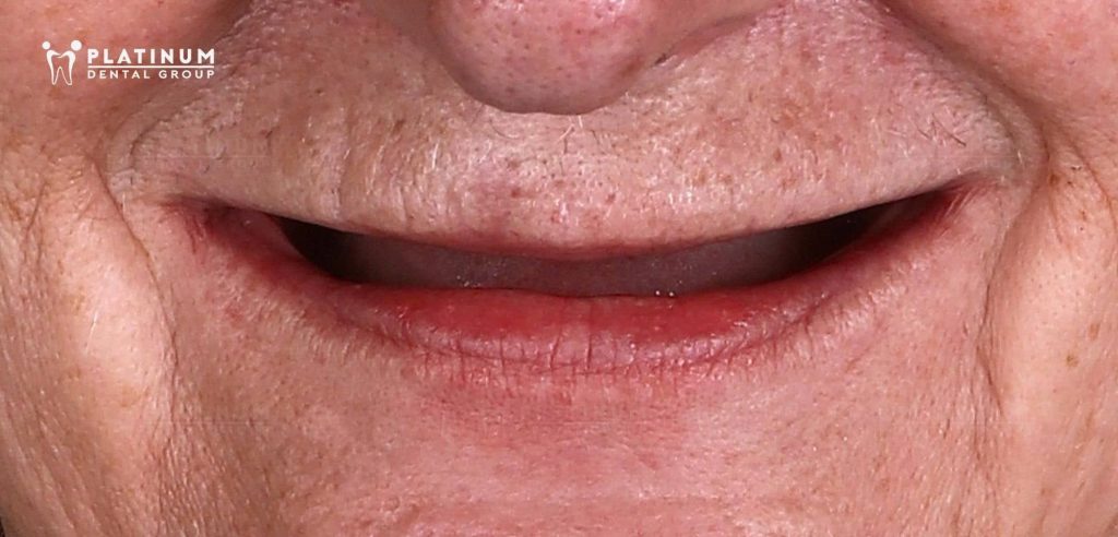 Khuôn miệng của cô Linda khi mất răng toàn bộ và dùng hàm giả đã 3 năm